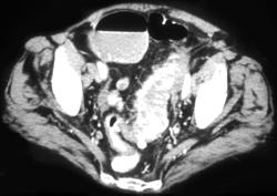 Diverticulitis - CTisus CT Scan