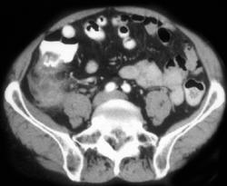 Cecal Cancer - CTisus CT Scan