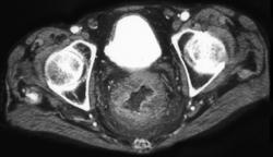 Rectal Cancer - CTisus CT Scan