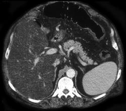 Ischemic Colitis of the Splenic Flexure - CTisus CT Scan