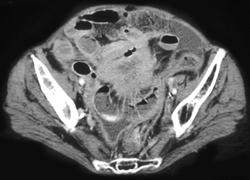 Recurrent Colon Cancer in the Root of the Mesentery - CTisus CT Scan