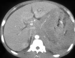 Lymphoma Involves the Colon - CTisus CT Scan