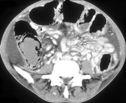 Pneumatosis - CTisus CT Scan