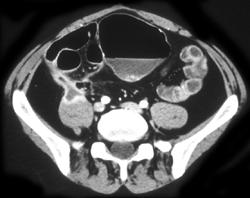 Crohn's With Fistulae to Psoas - CTisus CT Scan