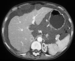 Pseudomyxoma Peritonei (PMP) - CTisus CT Scan