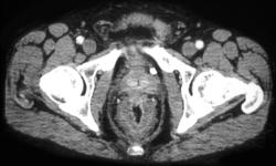 Rectal Cancer - CTisus CT Scan