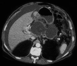 Carcinomatosis - CTisus CT Scan