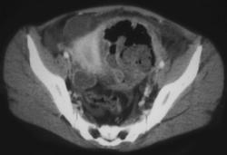 Abscess Due to Diverticulitis - CTisus CT Scan