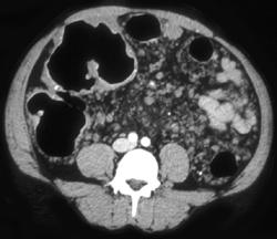 Hemangiomatosis - CTisus CT Scan