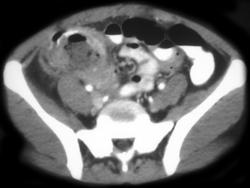 Perforated Appendicitis - CTisus CT Scan