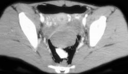 Pneumoperitoneum - CTisus CT Scan