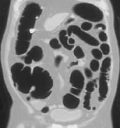 Retained Barium Simulates A Polyp - CTisus CT Scan