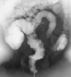 Hemangiomatosis of the Colon - CTisus CT Scan