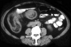 Colon Cancer With Intussusception - CTisus CT Scan