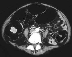 Cecal Cancer - CTisus CT Scan