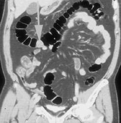 Pseudopolyp in Colon - CTisus CT Scan