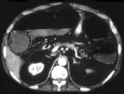 Infarcted Bowel With Air in Portal Venous System - CTisus CT Scan