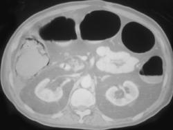 Pneumatosis of the Right Colon - CTisus CT Scan