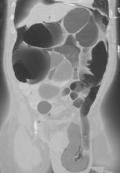 Infarcted Colon - CTisus CT Scan