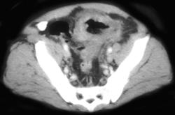 Fistulae From Colon to Bladder Due to Colon Cancer - CTisus CT Scan