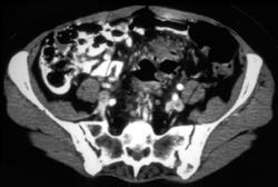 Diverticulitis - CTisus CT Scan