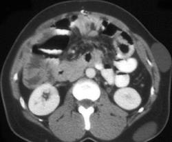 Metastatic Colon Cancer in Gardners Syndrome Patient (subcutaneous Cysts) - CTisus CT Scan