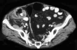 Ischemic Cecum - CTisus CT Scan