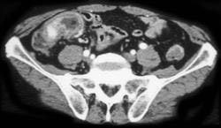 Cecal Cancer - CTisus CT Scan