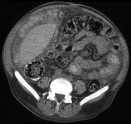 Carcinomatosis From Colon Cancer - CTisus CT Scan