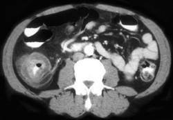 Infected Colitis in Right Colon - CTisus CT Scan