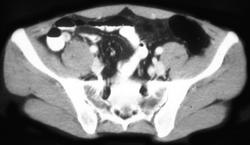 Appendicitis - CTisus CT Scan