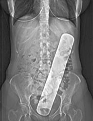 Retained Foreign Body - CTisus CT Scan