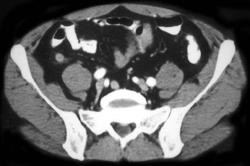 Appendicitis - CTisus CT Scan