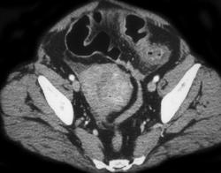 Ischemic Colitis - CTisus CT Scan