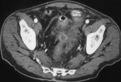 Diverticulitis With Fistulae to Bladder - CTisus CT Scan