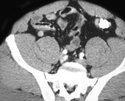 Diverticulitis - CTisus CT Scan