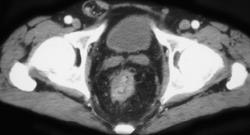 Colitis - CTisus CT Scan