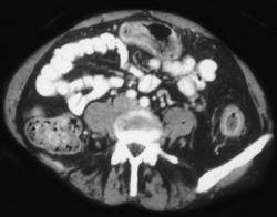 Ulcerative Colitis - CTisus CT Scan