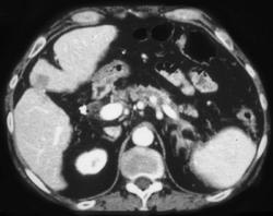 Ulcerative Colitis - CTisus CT Scan