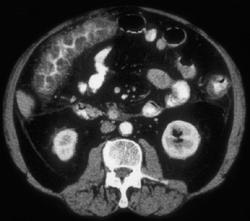 Pseudomembranous Colitis (PMC) - CTisus CT Scan