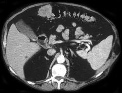 Transverse Colon Cancer - CTisus CT Scan