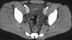 Pseudomyxoma Peritonei (PMP) - CTisus CT Scan