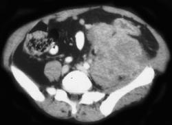 Recurrent Colon Cancer Invades Psoas - CTisus CT Scan