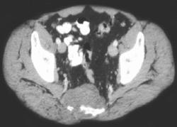 Recurrent Rectal Cancer Invades Sacrum - CTisus CT Scan