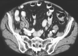 Cecal Cancer Obstructs Appendix - CTisus CT Scan