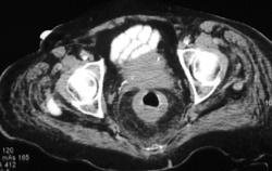 Ischemic Colitis - CTisus CT Scan