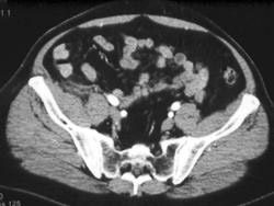 Appendicitis - CTisus CT Scan