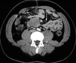 Carcinoid in Root of Mesentery - CTisus CT Scan