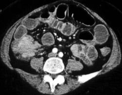 Cecal Cancer - CTisus CT Scan