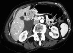 Gastric Cancer Extends to Transverse Colon - CTisus CT Scan